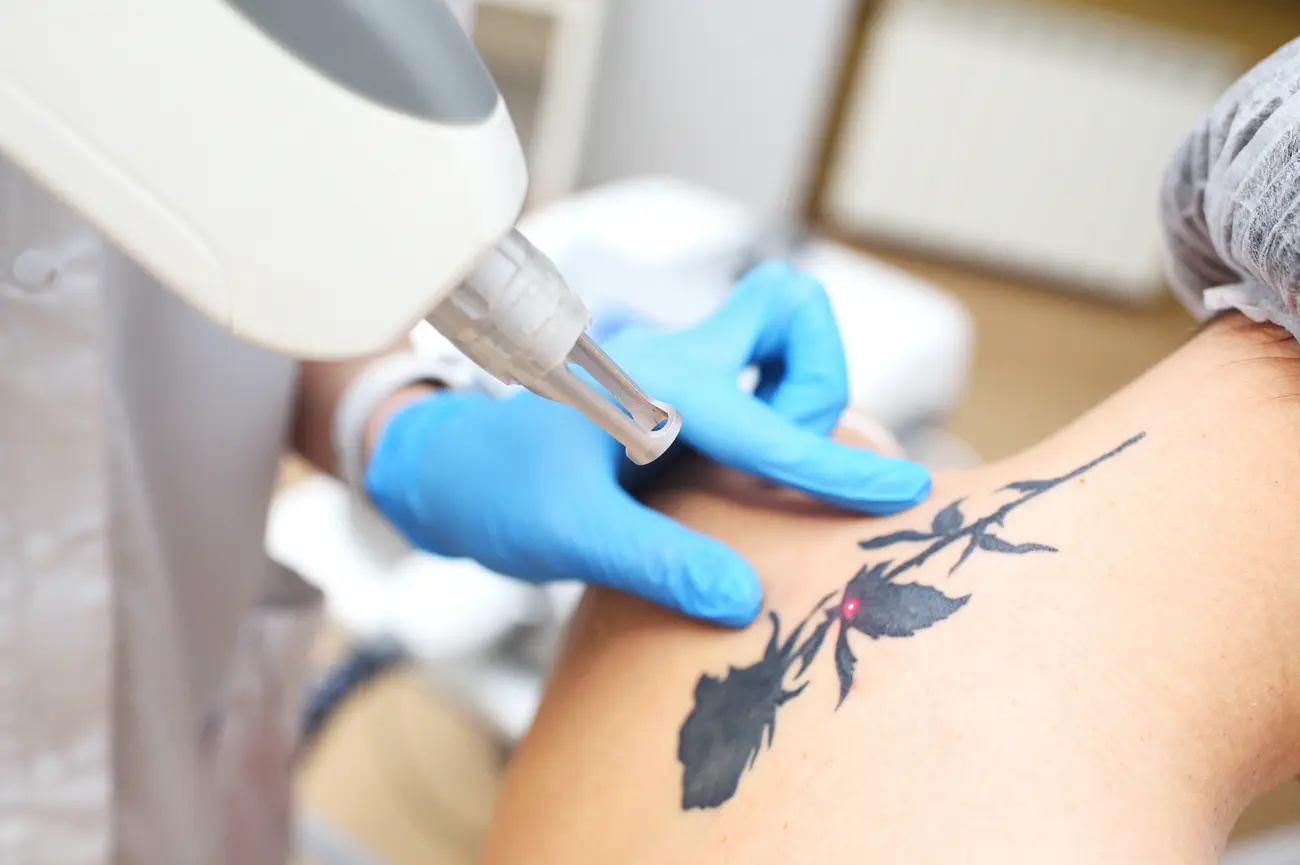 cosmetologist removes the tattoo to the patient us 2023 11 27 04 56 49 utc